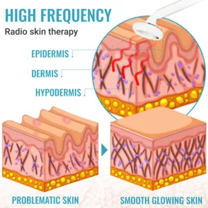 High Frequency Massager, High Frequency Wand Anti Age Hair Loss Wrinkles Acne