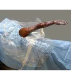 Shoulder Arthroscopy Drape by DHWANIT ENTERPRISE