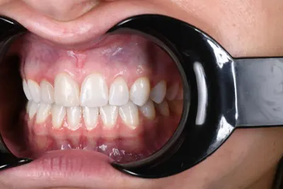 Mouth Opener