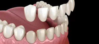Implant crown