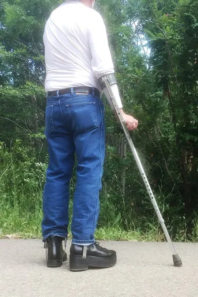 Hip Prosthesis 1