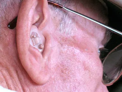 Drainage For Ear