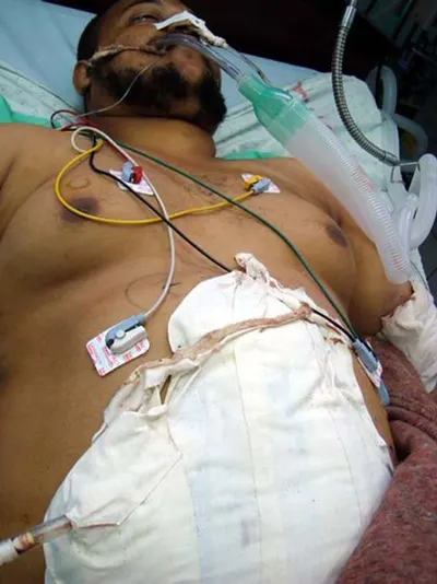 Male External Catheter