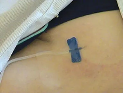 Disposable Laparoscopic Maryland Dissect