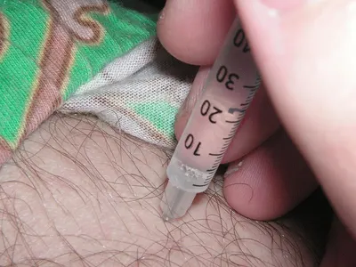 mental of auxin pen