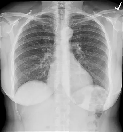 Pneumofil wastes