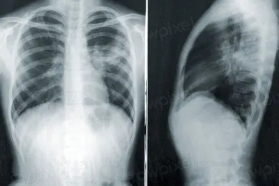 Xray dry film
