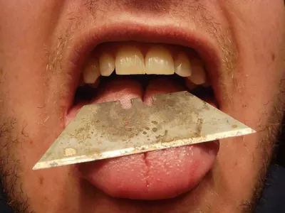Face veneer